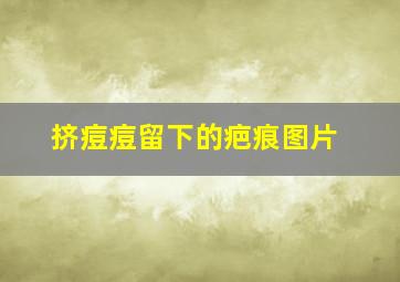 挤痘痘留下的疤痕图片