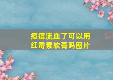 痘痘流血了可以用红霉素软膏吗图片