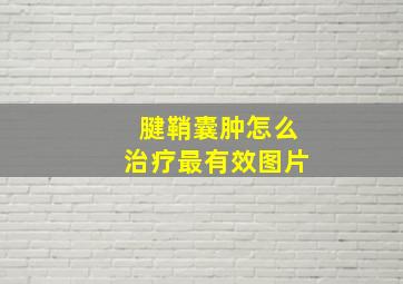 腱鞘囊肿怎么治疗最有效图片