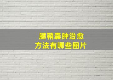 腱鞘囊肿治愈方法有哪些图片