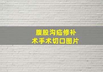 腹股沟疝修补术手术切口图片